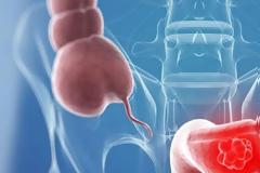 Τα ύποπτα σημάδια του καρκίνου του παχέος εντέρου