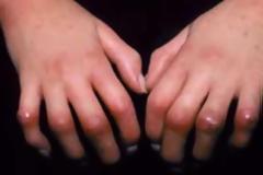 Σκληρόδερμα, μια χρόνια ρευματική πάθηση. Αν είστε ασθενής τι πρέπει να κάνετε;