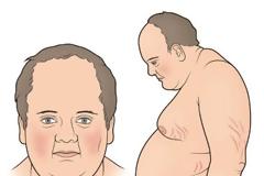 Σύνδρομο Cushing, με αύξηση βάρους, εύκολη κόπωση, υπέρταση, διαβήτη, αγχώδεις διαταραχές