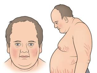 Φωτογραφία για Σύνδρομο Cushing, με αύξηση βάρους, εύκολη κόπωση, υπέρταση, διαβήτη, αγχώδεις διαταραχές