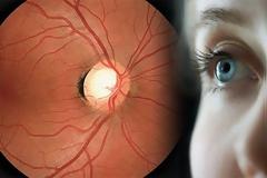 Γλαύκωμα. Κύρια αιτία τύφλωσης. Προκαλεί πονοκέφαλο, θολή όραση, πόνο στα μάτια, ναυτία