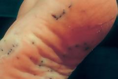 Πρώτες βοήθειες αν πατήσετε αχινό, δράκαινα, τενεκεδάκι, γυαλί στην παραλία