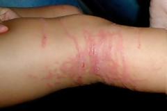 Σας τσίμπησε μέδουσα, τσούχτρα; Διαβάστε τι πρέπει να κάνετε