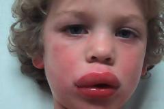 Aναφυλαξία, αναφυλακτικό, αλλεργικό shock. Πώς γίνεται η ένεση αδρεναλίνης; Mέτρα πρόληψης (video)