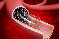 Ωνάσειο: Επιτυχής αγγειοπλαστική σε πνευμονικές φλέβες