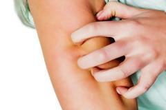 Τρόποι για ν’ απαλλαγείτε από τη φαγούρα του τσιμπήματος των κουνουπιών - Τι μπορείτε να κάνετε