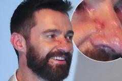 Βασικοκυτταρικό Καρκίνωμα, η πιο συνηθισμένη μορφή καρκίνου του δέρματος (φωτο)