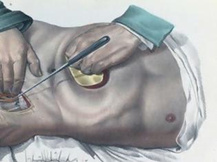 Φωτογραφία για Πώς γίνονταν οι χειρουργικές επεμβάσεις το 1840 - ΣΥΓΚΛΟΝΙΣΤΙΚΕΣ εικόνες από χειρουργεία ΧΩΡΙΣ ΑΝΑΙΣΘΗΤΙΚΟ... [photos]