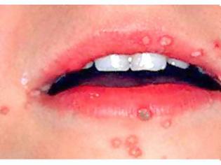 Φωτογραφία για Οι HPV ιοί ανιχνεύονται σε ποσοστό 35-45% στο στόμα