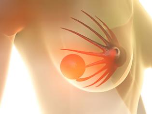 Φωτογραφία για Έρευνα αποδεικνύει την αποτελεσματικότητα της ριμποσικλίμπης στον προχωρημένο καρκίνο του μαστού.