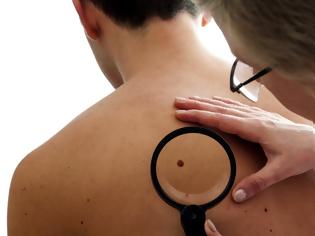 Φωτογραφία για Έρευνα: Γιατί το σολάριουμ απειλεί με καρκίνο του δέρματος τους ομοφυλόφιλους στις ΗΠΑ