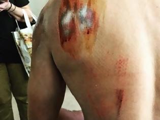 Φωτογραφία για Σοβαρά τραυματίας ποδηλάτης αστυνομικός μετά από επίθεση σκύλου στη Λυσιμαχία (φωτο)