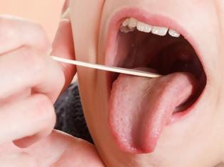 Φωτογραφία για Έρευνα για την πρόγνωση μεταστάσεων του ακανθοκυτταρικού καρκίνου του στόματος