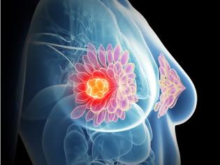 Φωτογραφία για Η σημασία της έγκαιρης διάγνωσης στον καρκίνο του μαστού. Εγκυμοσύνη και θηλασμός μετά από μαστεκτομή