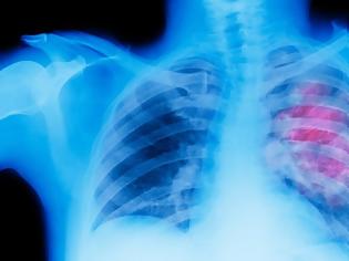 Φωτογραφία για Καρκίνος του πνεύμονα: H πιο συχνή μορφή καρκίνου στους άνδρες, η τρίτη στις γυναίκες