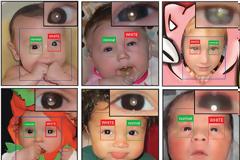 Παιδιά: Εφαρμογή για smartphone εντοπίζει οφθαλμοπάθειες στις φωτογραφίες