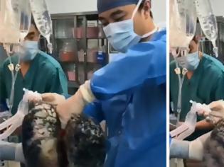 Φωτογραφία για Χειρουργός στην Κίνα δείχνει πως μοιάζουν οι πνεύμονες ενός καπνιστή επί 30 χρόνια (video)