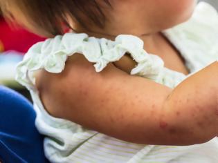 Φωτογραφία για ΠΟΥ: 140.000 θάνατοι το 2018 από ιλαρά -Κυρίως ανεμβολίαστα παιδιά τα θύματα