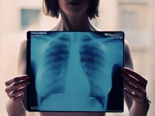 Φωτογραφία για Σύστημα της Google γνωματεύει ακτινογραφίες των πνευμόνων εξίσου καλά με ακτινολόγους