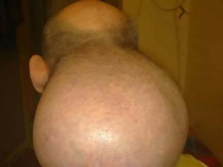 Φωτογραφία για Εικόνες σοκ από τις Σέρρες: Κρατούμενος με όγκο στο κεφάλι που μεγαλώνει συνεχώς! Το ξέσπασμα και η κραυγή αγωνίας του (ΕΙΚΟΝΕΣ)