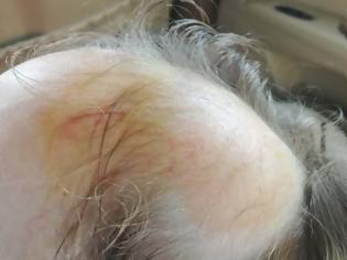 Φωτογραφία για Σοκαριστικό ατύχημα σε Νηπιαγωγείο του Αγρινίου: Ξεριζώθηκαν από κούνια τα μαλλιά πεντάχρονης!