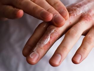Φωτογραφία για Πώς να περιποιηθείτε τα χέρια σας για την δερματίτιδα από το πλύσιμο και τα γάντια