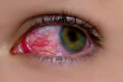 Αίμα στο μάτι από σπασμένα αιμοφόρα αγγεία,  Υπόσφαγμα