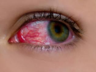 Φωτογραφία για Αίμα στο μάτι από σπασμένα αιμοφόρα αγγεία,  Υπόσφαγμα