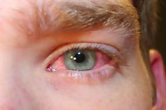 Επιπεφυκίτιτδα σε ένα ποσοστό ασθενών από κοροναϊό