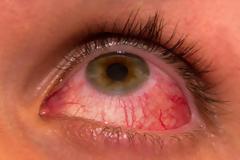 Επιπεφυκίτιδα με τσίμπλα, δάκρυα, πρήξιμο, κόκκινα ερεθισμένα μάτια