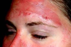 Αντιμετωπίστε την Ηλίαση και την Θερμοπληξία. Πρώτες βοήθειες