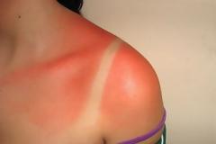 Προσέχουμε τον ήλιο το Πάσχα και Βάζουμε αντηλιακό