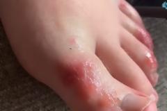 Τι είναι το δυσάρεστο σύμπτωμα στα πόδια που εμφανίζουν κάποιοι ασθενείς και δείχνουν κοροναϊό