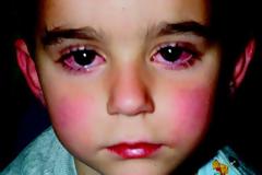 Νόσος ή σύνδρομο Καβασάκι Kawasaki. Κάνει υψηλό πυρετό, επιπεφυκίτιδα, εξάνθημα, πρησμένα χέρια, κόκκινα χείλη