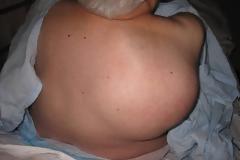 Σάρκωμα μαλακών μορίων. Κακοήθης όγκος μαλακών ιστών, μυών, νεύρων, αγγείων του οργανισμού