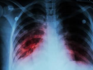 Φωτογραφία για Εκατομμύρια νέα κρούσματα φυματίωσης λόγω κοροναϊού