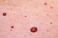 Kόκκινες ελιές στο δέρμα (κερασοειδή αιμαγγειώματα). Είναι επικίνδυνες; Πώς αντιμετωπίζονται;