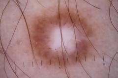 Δερματοΐνωμα δερματική βλάβη που μοιάζει με σπυράκι, είναι σκληρό σαν να έχει κάτι μέσα