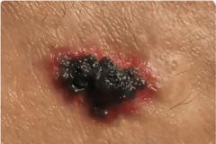 Μελάνωμα, καρκίνος του δέρματος που σκοτώνει. Ποιοι κινδυνεύουν; Πώς θα το καταλάβετε;