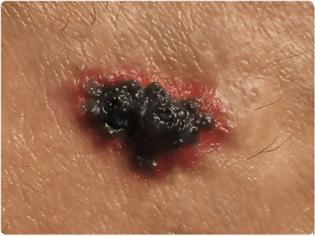 Φωτογραφία για Μελάνωμα, καρκίνος του δέρματος που σκοτώνει. Ποιοι κινδυνεύουν; Πώς θα το καταλάβετε;