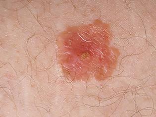 Φωτογραφία για Προσοχή μοιάζει με σπυράκι, η Νόσος του Bowen, ενδοεπιδερμιδικός ακανθοκυτταρικός καρκίνος του δέρματος