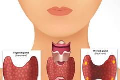Πίνακας εξετάσεων του θυρεοειδή αδένα. Υποθυρεοειδισμός, Υπερθυρεοειδισμός, Καρκίνος