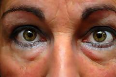 Μαύροι κύκλοι, σακούλες στα μάτια. Ποιες οι αιτίες; Φυσικά μέσα, σπιτικές μάσκες ματιών για αντιμετώπισή τους