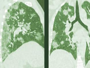 Φωτογραφία για Καρκίνος του πνεύμονα: Πως τον επηρεάζει η νικοτίνη