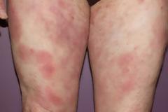 Σπογγοειδής μυκητίαση, δερματικό λέμφωμα Τ-κυττάρων μια σπάνια μορφή κακοήθειας non-Hodgkin λεμφώματος