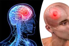 Καρκίνος στον εγκέφαλο, όγκος με ζαλάδες, πονοκέφαλο, ναυτία, αστάθεια, σπασμοί