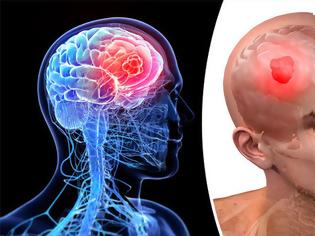 Φωτογραφία για Καρκίνος στον εγκέφαλο, όγκος με ζαλάδες, πονοκέφαλο, ναυτία, αστάθεια, σπασμοί