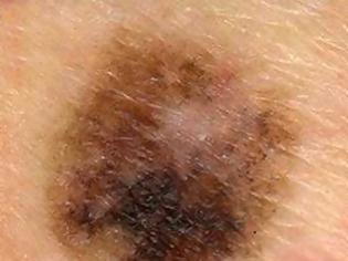 Φωτογραφία για Κακοήθεις όγκοι του δέρματος. Χαρακτηριστικά που έχουν οι ελιές που προειδοποιούν για πιθανό καρκίνο