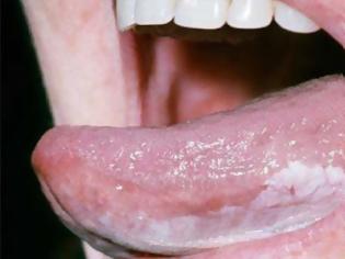 Φωτογραφία για Λευκοπλακία Προκαρκινική βλάβη στο στόμα που πρέπει να αφαιρείται