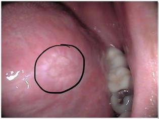 Φωτογραφία για Καρκίνος στόματος. Που οφείλεται, ποια τα συμπτώματα και πώς γίνεται η αυτοεξέταση (video)